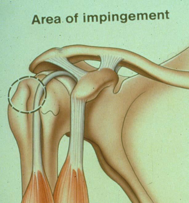 Impingement Syndrome Most