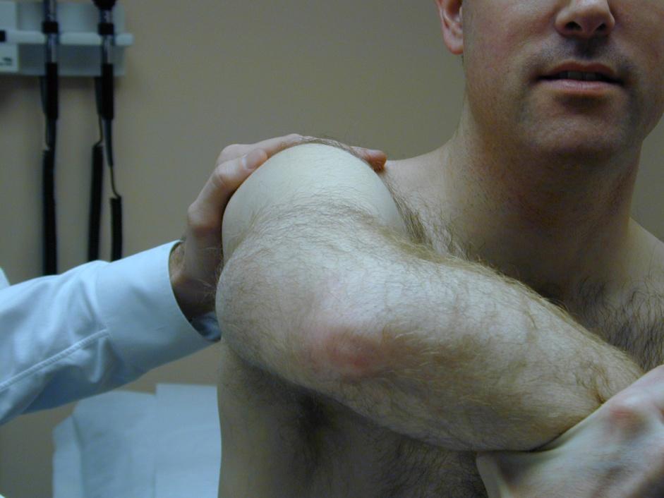 Diagnosis of Impingement History» pain with overhead activity» pain at night; +/- weakness Examination» Neer and Hawkins
