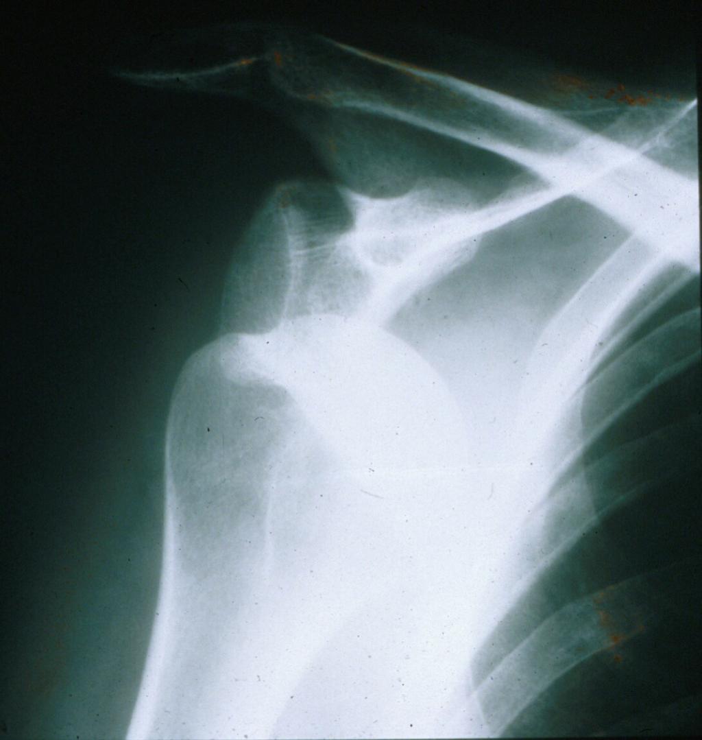 Shoulder Instability: Imaging MUST have axillary view or