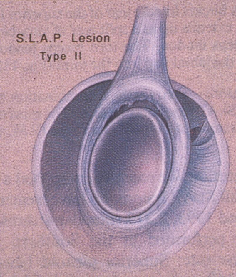 SLAP Lesion