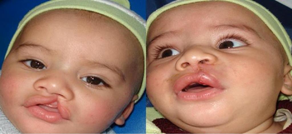 Figure 5: pre-operative and post-operative photos of acase with incomplete cleft lip and palate. outcome: After follow up periods the data was analysed as follow: 1.
