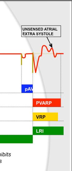 Four Fundamental Timing Cycles QRS COMPLEX VENTRI EXTRA SYSTOLE UND EXTRA SYSTOLE 3 pavi pavi savi AVI pavi 4 2 VRP VRP VRP VRP VRP VRP 1 Scheduled ventricular stimulus after AVI A ventricular sense