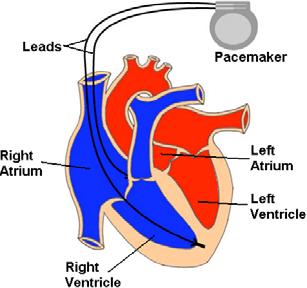 leads with electrodes that are in contact with the heart May detect natural cardiac stimulations,