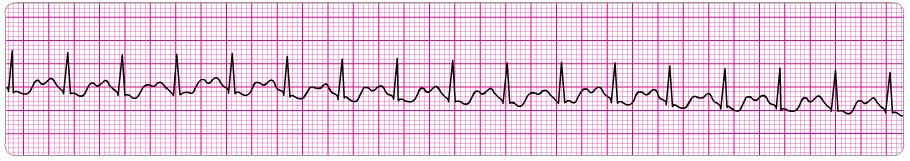 3. Atrial rate: Ventricular rate: P waves: QRS: Intervals: Regular; P to P is regular, >100 bpm Regular; R to R is regular, >100 bpm P wave before every QRS complex Unchanged unless