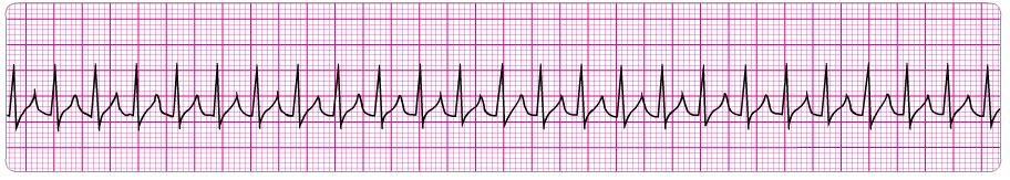 beat or increased rate PR: not measureable QRS: <0.