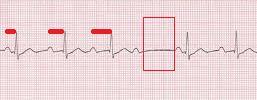 2ND DEGREE AV HEART BLOCK A 2 nd degree AV block is usually classified as Mobitz Type I (Wenckebach) or Mobitz Type II.