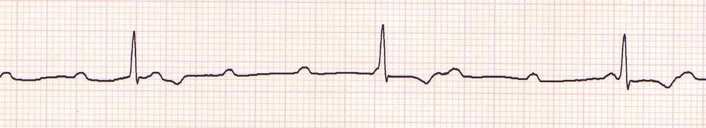 3RD DEGREE HEART BLOCK A 3rd degree heart block (sometimes called a complete heart block) is a rhythm in which there is no