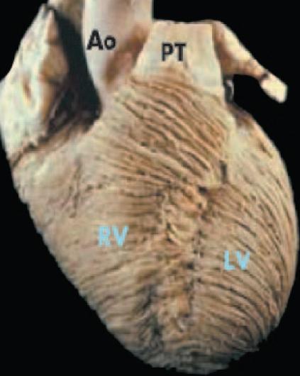 Normal anatomy and physiology of the RV - Complex geometry, crescent-shaped - Heavily