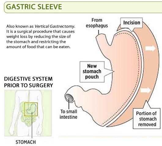 Bariatric Surgery Gastric