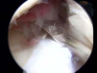 anatomic repair with a high degree of accuracy and reproducibility transtibial tunnel drilling may enhance