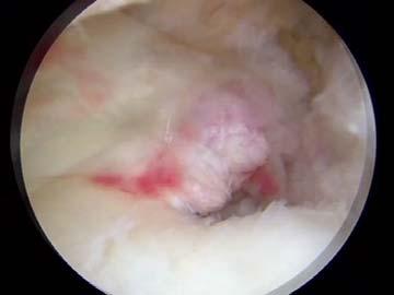 should focus on eliminating nonanatomic displacement following repair Repair of a posterior meniscal root tear