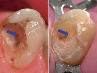 It is important to obtain immediate and hermetic sealing of the prepared cavity to avoid recontamination.