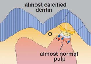 Fig 7a Graphic representation of laser-assisted pulp capping and of formation of dentinal bridge.