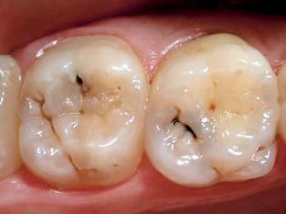 Fig 8 Pulp exposure (tooth 16) with moderate bleeding.