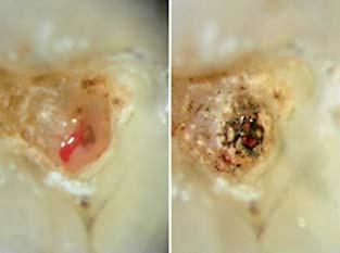 dentinal tubules performed with Er,Cr:YSGG laser.