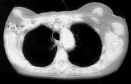 nonevaluable (all cohort B) Response data GVAX Lung
