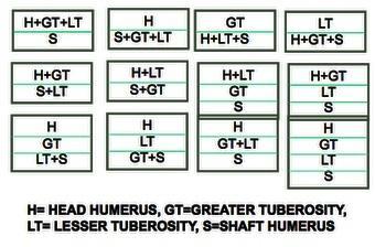 jedan prijelom koji dijeli humerus u 4 fragmenta. Hertlova klasifikacija pokazuje najveću intraobservacijsku pouzdanost (Slika 3.) Slika 3. Hertelova klasifikacija 7.