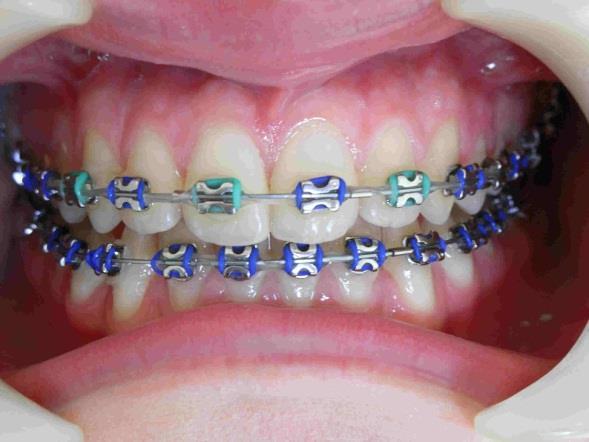 Introduction - Orthodontics Orthodontics: treating patients with improper position of teeth when the mouth is closed, which results