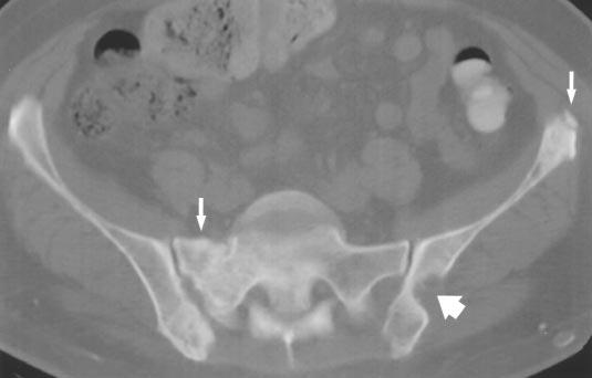 , xial T image of pelvis reveals multiple sclerotic bony metastases (thin arrows) involving right half of sacrum and left