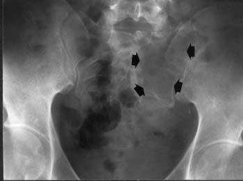 Fig. 1 An anteroposterior radiograph of the pelvis shows a large osteolytic lesion in the left sacrum (arrows).