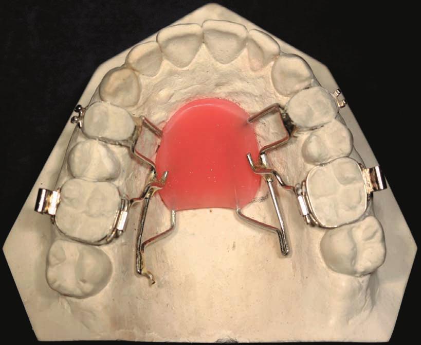 Once activated, the device will promote the molar