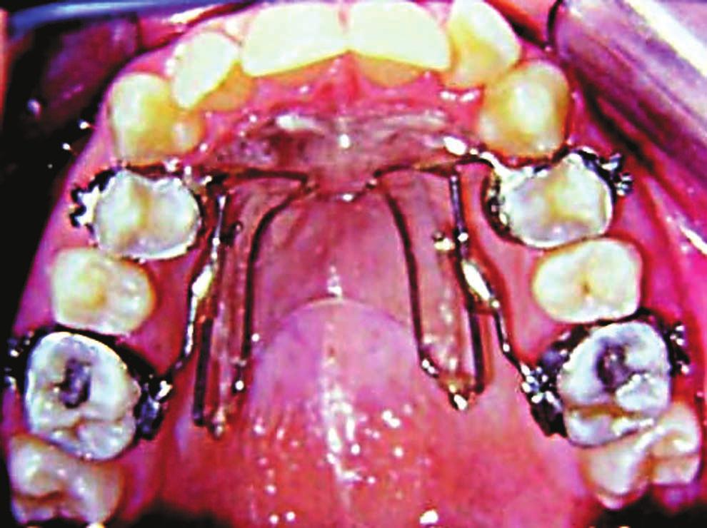 , 2001). Fig. 15. Case 2 distalization of the first molar.