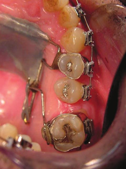 adverse effects such as distal inclination of the molar (tipping), anchorage loss, extrusion, lip protrusion, The design of the elastic distalizer, however,