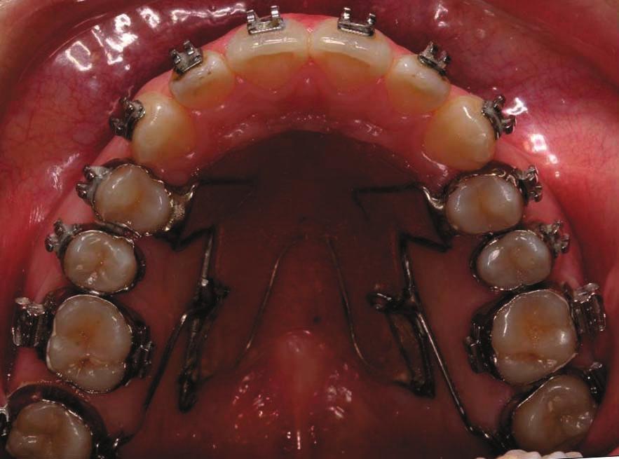 Distal inclination is decreased due to both stiffness of the wire used for making the distalizing device and proximity between force and tooth s resistance
