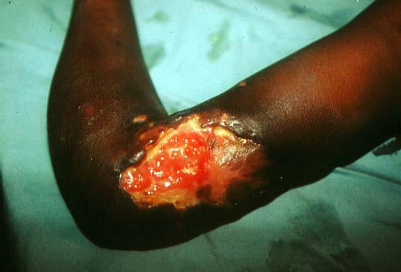 9 Fig 13 Fig 14 Buruli Ulcer with characteristic undermining of the edges (Courtesy of Dr.