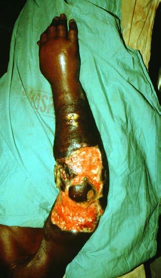 any chronic wound as a decubitus ulcer or tropical ulcer. Most Marjolin s ulcers are on the lower extremity but it can appear on the upper extremity as well as the scalp.