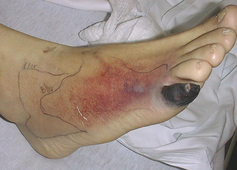 Seven Key Questions Is the wound infected? Is the wound ischemic? Is there pressure?