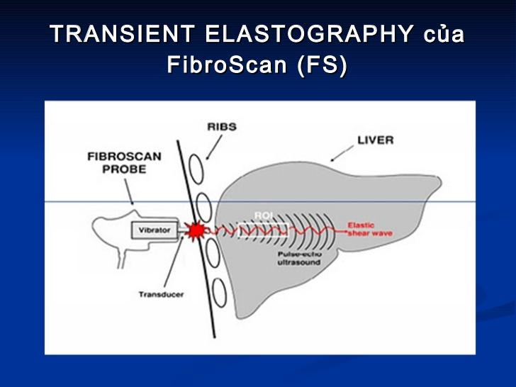 Non-invasive Staging Transient Elastography: MR Elastography: US probe delivers