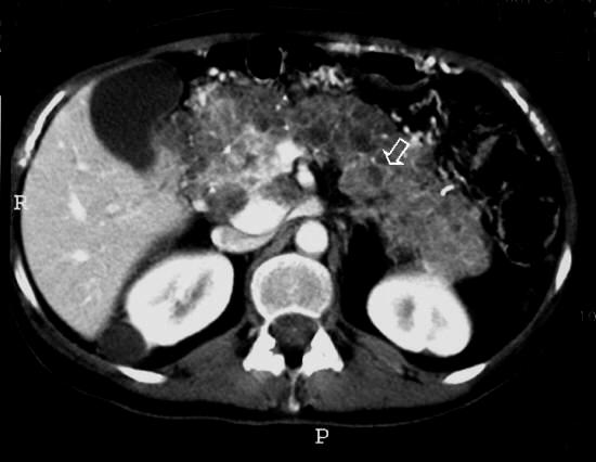 Image 2 kidney. During CT examination, multiple cysts of the pancreas were found.