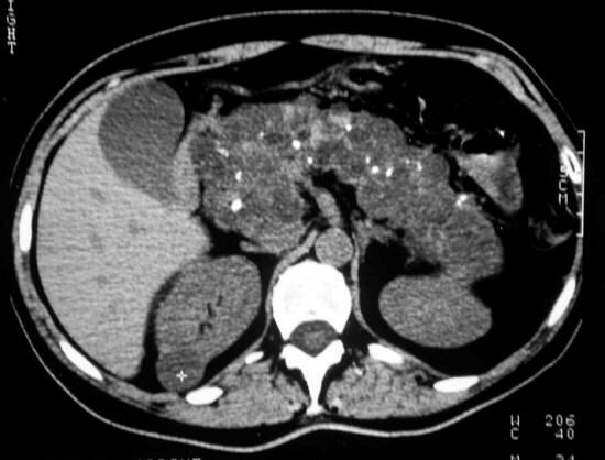 During CT examination, multiple cysts of the pancreas were found (Image 1): the arrow in the figure indicates right renal mass which appears inhomogeneous and hypodense.