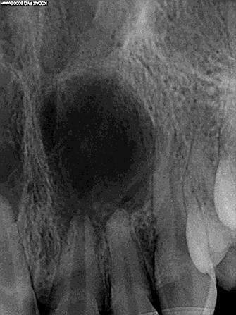 Following radiographic examination, obturation was completed on 12, 11 and 21 with gutta percha and AH Plus (Dentsply) sealer using lateral condensation technique after ensuring that the canals were