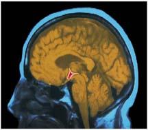 The Brain Limbic System a doughnut-shaped system of neural structures at the border of the brainstem and cerebral hemispheres associated with emotions such as