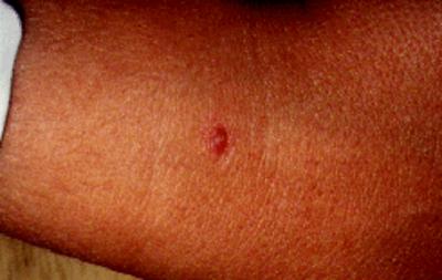LABORATORY DATA A tuberculosis (TB) skin test was placed on the flexor surface of John s right forearm, and blood was drawn for a Complete Blood Count with differential (CBC) to rule out any other