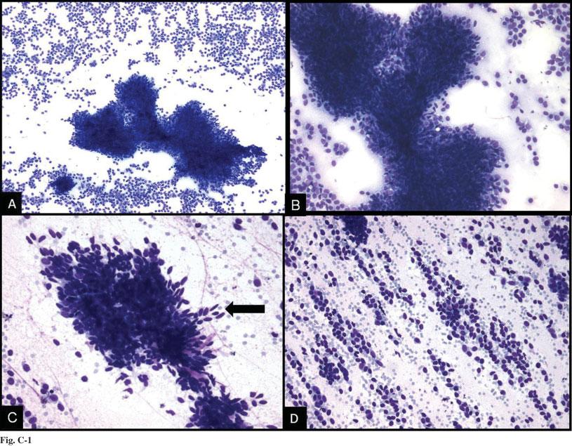 REID-NICHOLSON ET AL. Fig. C-1. A. Hypercellular smear with clusters and singly disposed basaloid cells (DQ stain, 340). B.