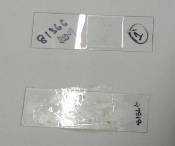 Fig.1 Slides of KOH mount by standard technique and cellophane tape method Fig.2 KOH mount of Tinea versicolor by standard technique Fig.