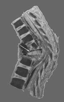 vertebral body Spreads to interverteberal disk