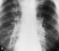 Reflects minimal cellular immune response Chest X-Ray Upper lobe infiltrate with or without cavity Hilar adenopathy with or without infiltrates Pleural effusion, exudative Lower lobe infiltrate