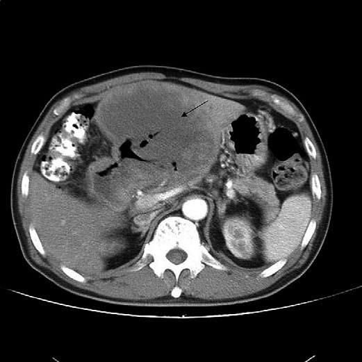 94 Primary gastric lymphoma with unusual imaging presentation a Figure. a. Primary gastric lymphoma involving the left lobe of the liver.