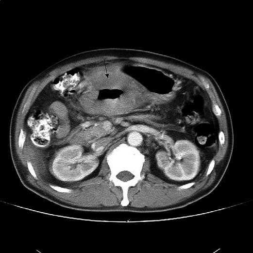 Diffuse large B-cell lymphoma of the stomach. Upper gastrointestinal series shows a large exophytic mass with central ulceration (arrow) in the lesser curvature of the antrum.