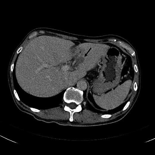 Primary gastric lymphoma with unusual imaging presentation 95 Figure 4. Contrast enhanced CT scan of upper abdominal after chemotherapy.