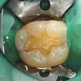 GC CAVITY CONDITIONER can be applied and then rinsed off to improve adhesion to the tooth structure.
