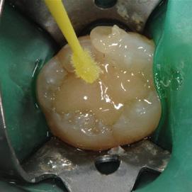Class II restorations * When compared with micro-hybrid composite resin over a period of 12 months, EQUIA was found to be as