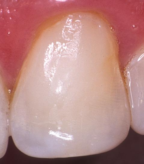 EQUIA Coat quickly and easily protects restorations, improves physical properties, and aesthetics.