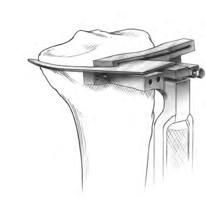 11 NexGen LPS Fixed Bearing Knee Surgical Technique Figure 19 Figure 20 Step Two (Saw): Resect the Tibia (cont.