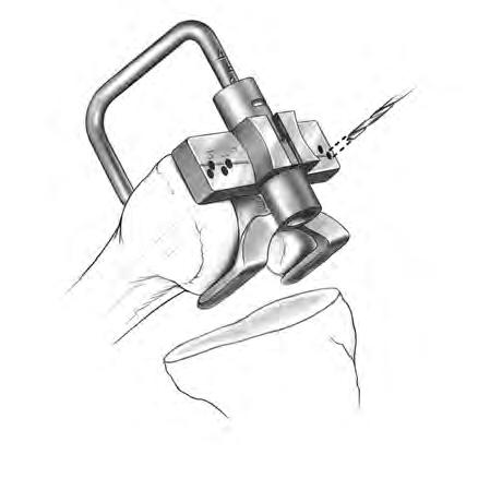Once the size has been chosen, this size indicates the proper size of the femoral A/P positioning guide, the femoral milling template or 5-in-1 femoral cutting guide, and the femoral finishing guide