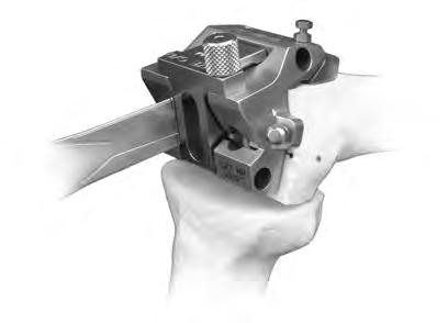 Place the TR/PS milling finishing guide on the cut surface of the distal femur with the anterior portion resting on the cut surface of the anterior femoral condyle.